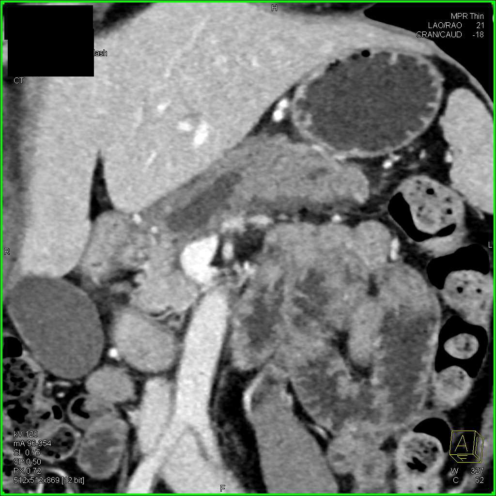 Carcinoma of the Pancreas with Obstructed Pancreatic Duct - CTisus CT Scan