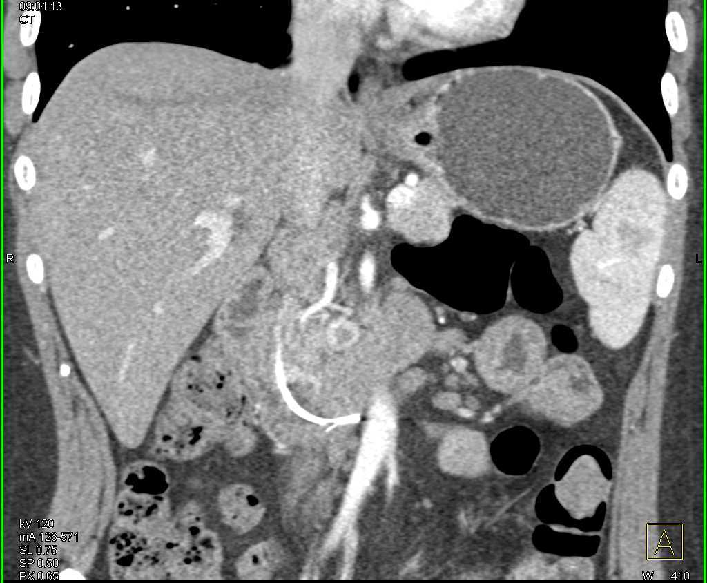 Neuroendocrine Tumor Head of Pancreas - CTisus CT Scan