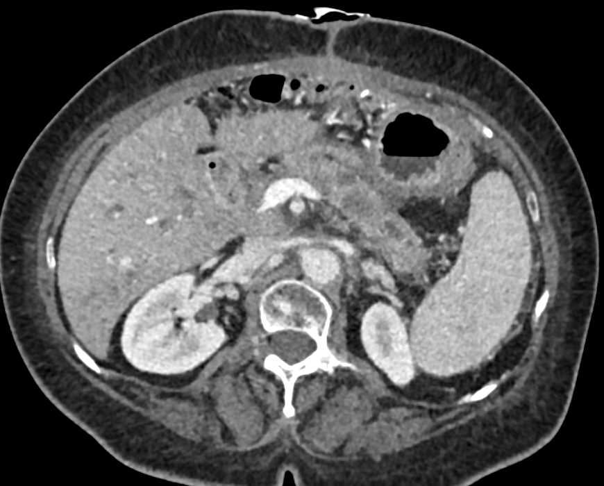 Pancreatic Cancer Encases the Portal Vein/SMV Junction - CTisus CT Scan