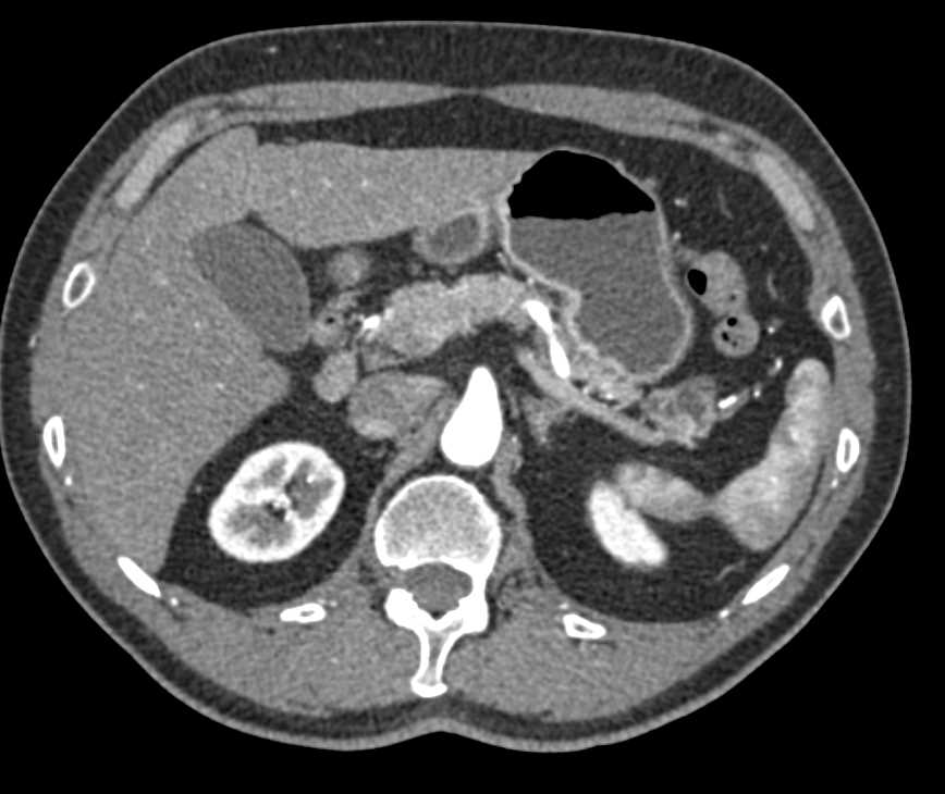 Intraductal Papillary Mucinous Neoplasm (IPMN) with High Grade Dysplasia Tail of Pancreas - CTisus CT Scan