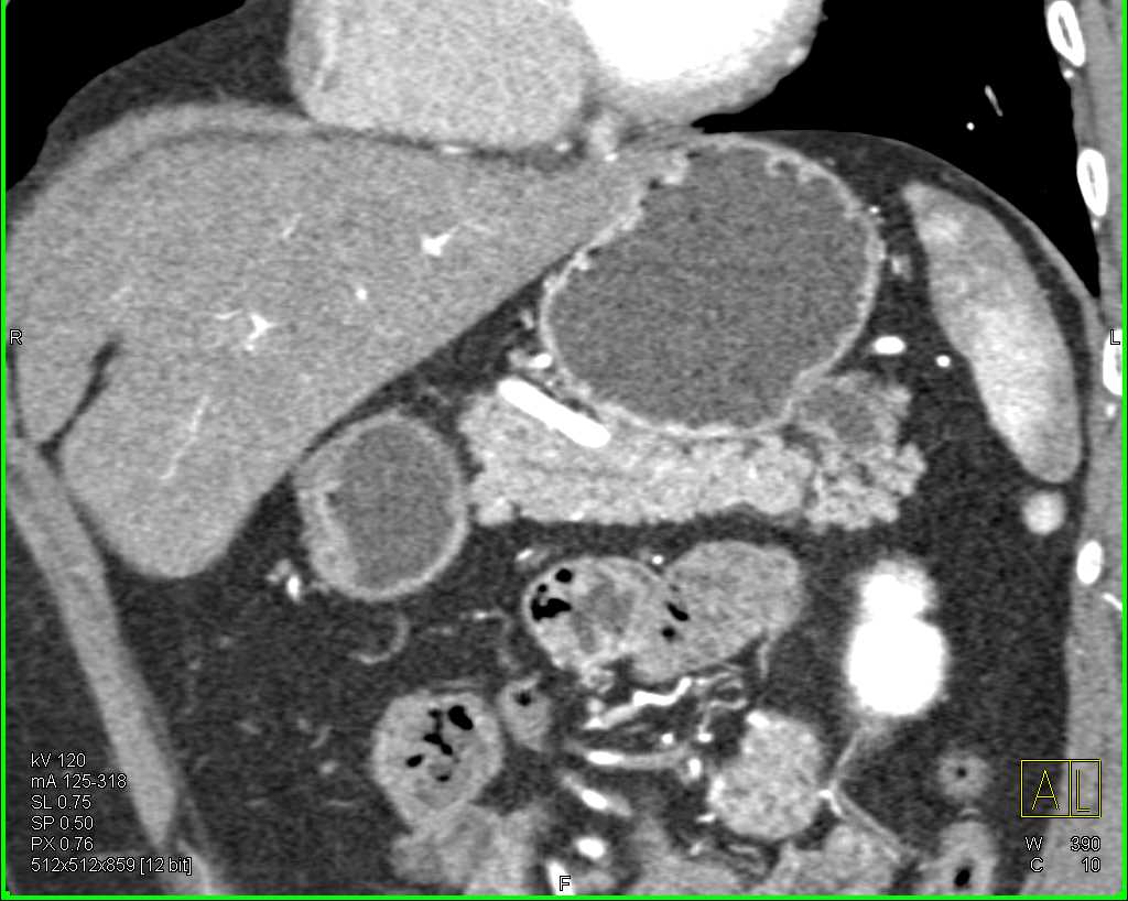 Intraductal Papillary Mucinous Neoplasm (IPMN) Tail of Pancreas - CTisus CT Scan