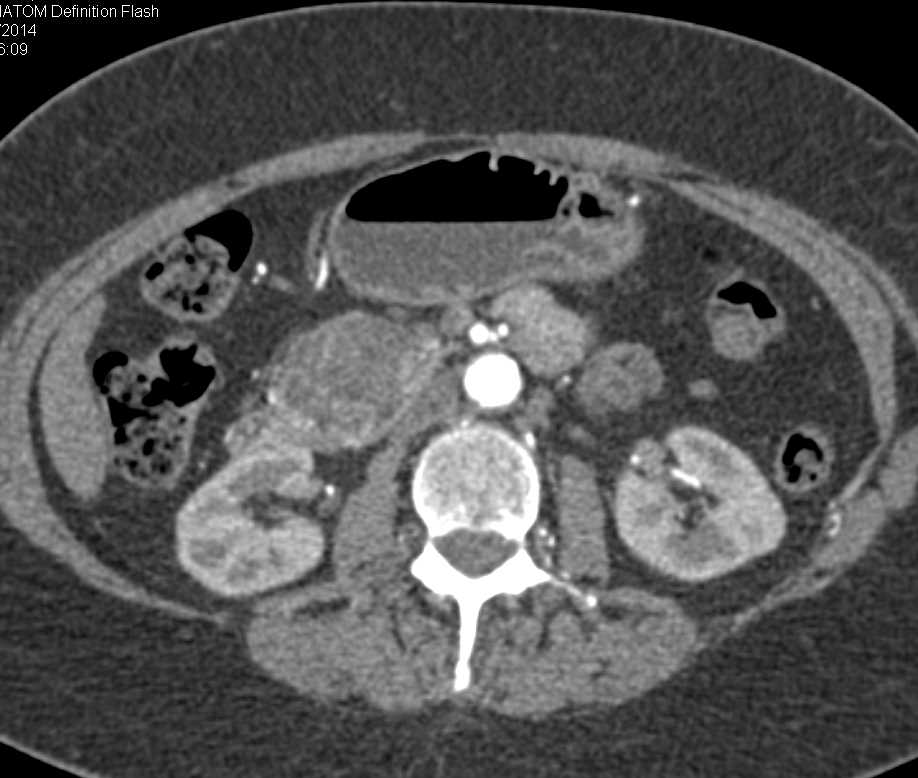 Serous Cystadenoma of the Pancreas - CTisus CT Scan