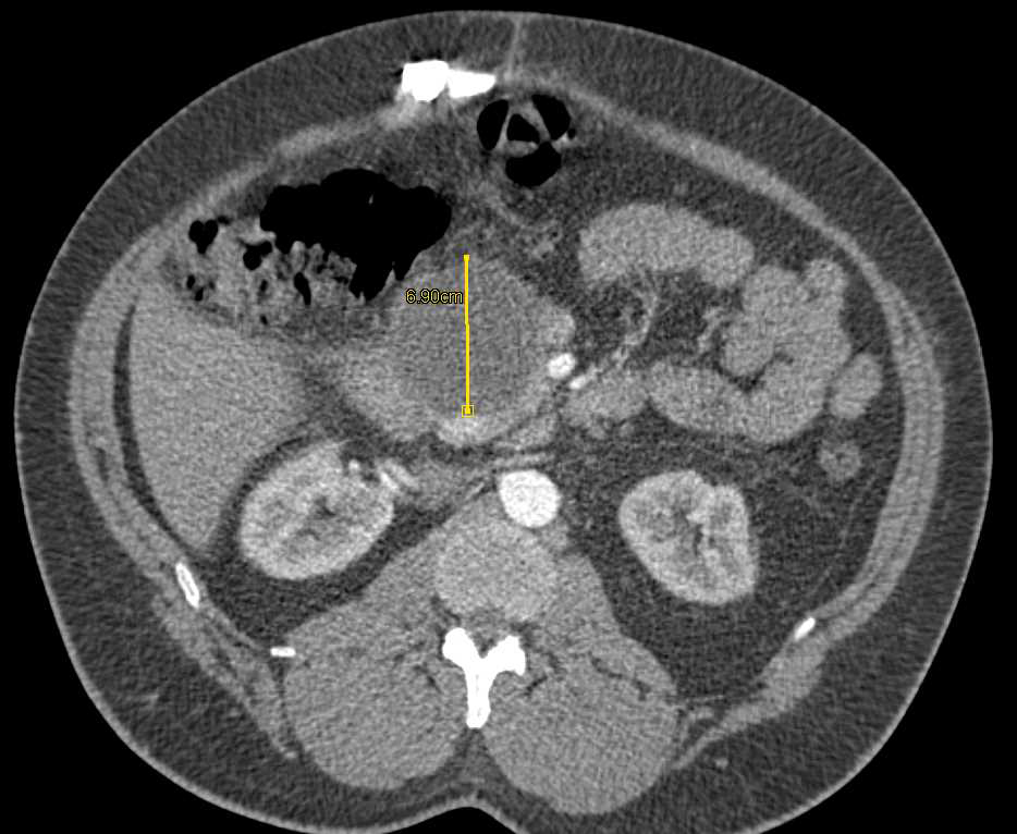 Serous Cystadenoma of the Pancreas - CTisus CT Scan