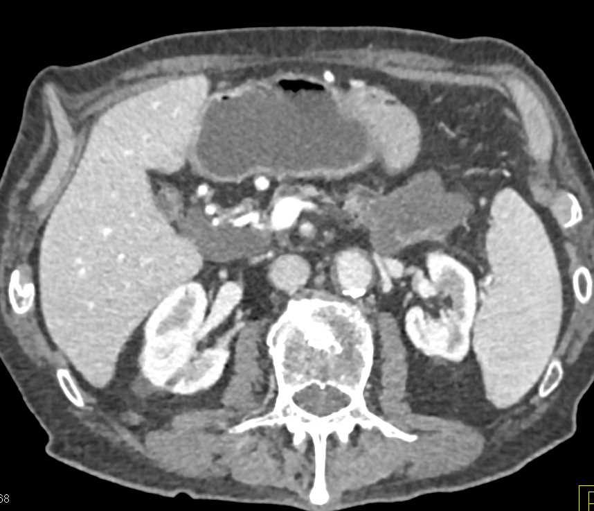 Adenocarcinoma Tail of Pancreas with Vascular Invasion - CTisus CT Scan