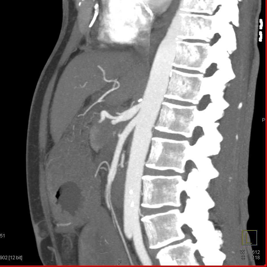 Pancreatic Cancer with Arterial Encasement - CTisus CT Scan