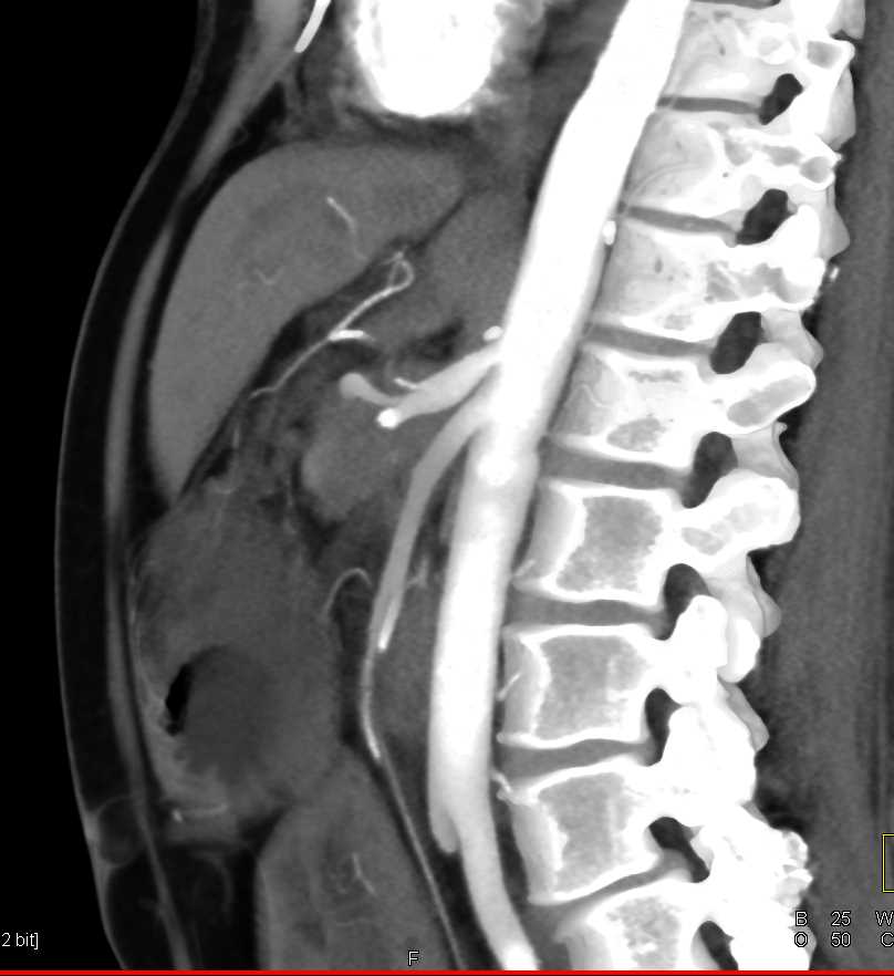 Pancreatic Cancer with Arterial Encasement and Venous Occlusion with Impressive Collaterals - CTisus CT Scan