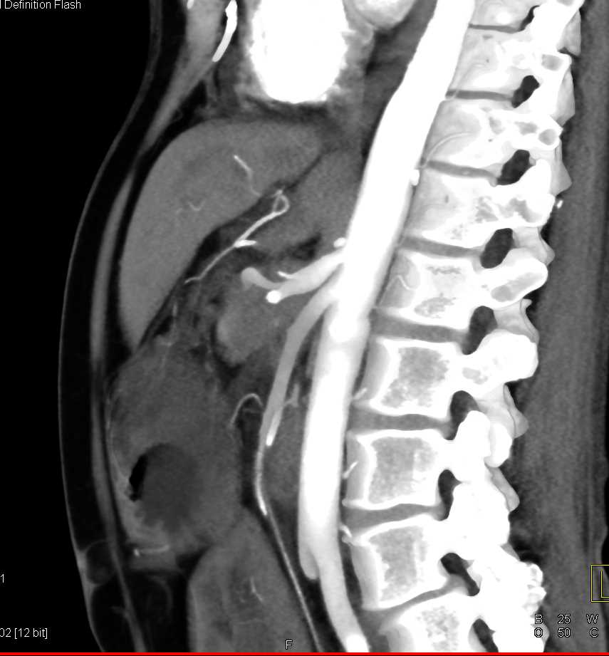 Pancreatic Cancer with Arterial Encasement and Venous Occlusion with Impressive Collaterals - CTisus CT Scan