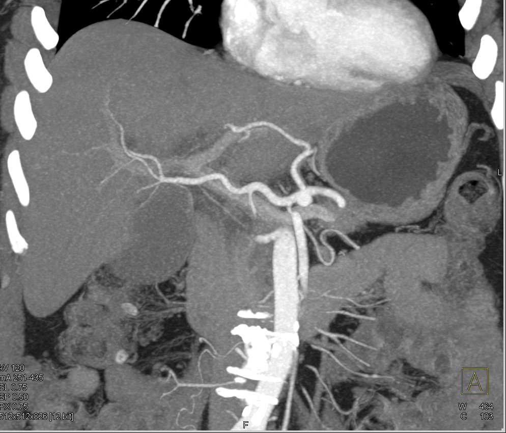 Hepatic Abscesses in Post Whipple Patient for Pancreatic Cancer Simulates Metastases with Bullseye Lesions - CTisus CT Scan