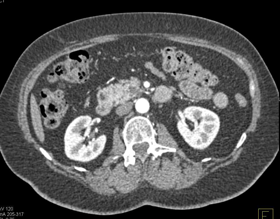 Subtle Carcinoma in the Uncinate Process - CTisus CT Scan