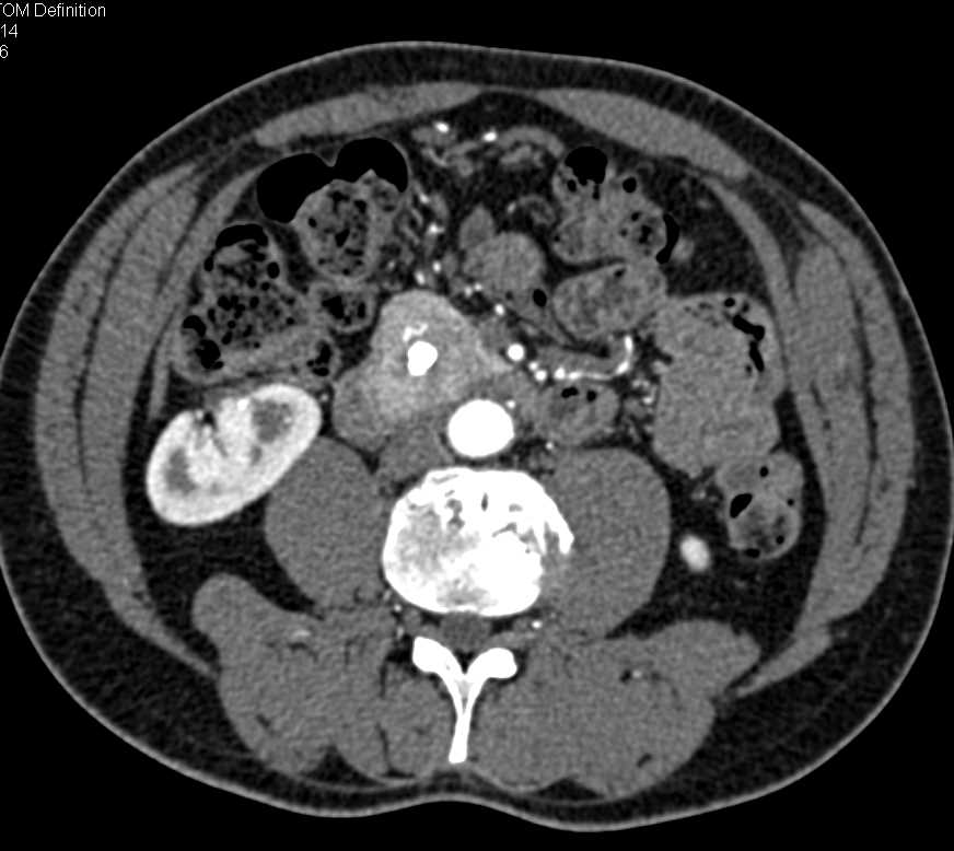 Neuroendocrine Tumor Head of Pancreas - CTisus CT Scan