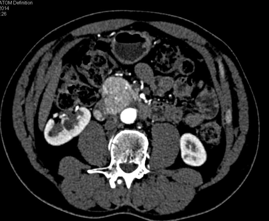 Neuroendocrine Tumor Head of Pancreas - CTisus CT Scan