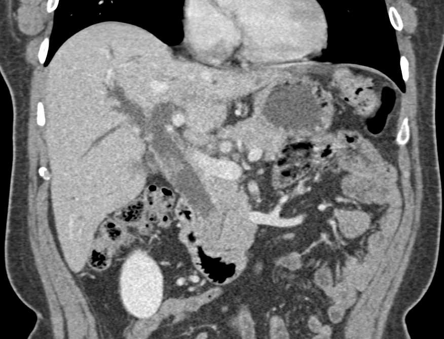 Ampullary Tumor with Obstructed Common Bile Duct - CTisus CT Scan