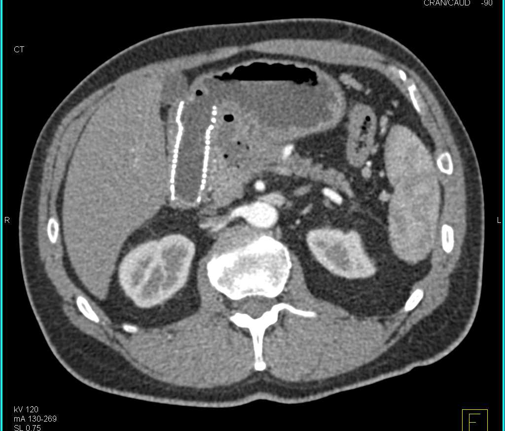 Pancreatic Cancer Invades the Duodenum with Stent in Place. Liver Metastases Also Seen - CTisus CT Scan