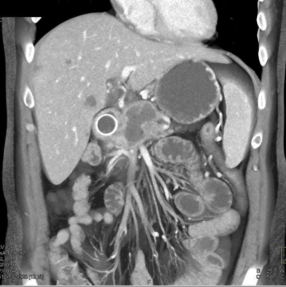 Pancreatic Cancer Invades the Duodenum and  Liver Metastases Also Seen - CTisus CT Scan