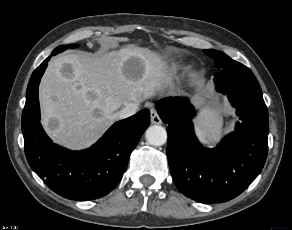 Infiltrating Pancreatic Cancer with Liver Metastases