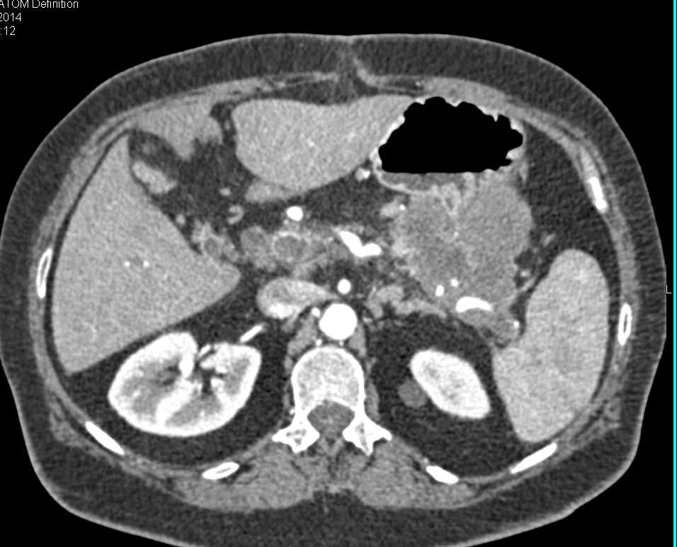 Large Adenocarcinoma of the Body and Tail of the Pancreas - CTisus CT Scan