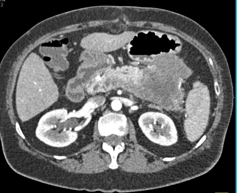 Large Adenocarcinoma of the Body and Tail of the Pancreas - Pancreas ...