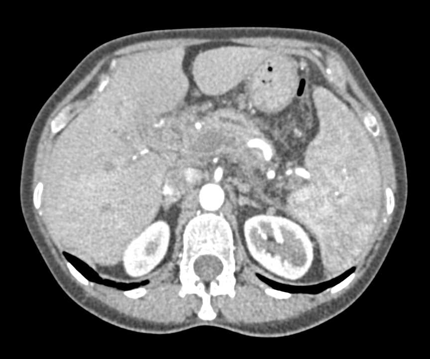 Pancreatic Adenocarcinoma with Arterial and Venous Involvement - CTisus CT Scan