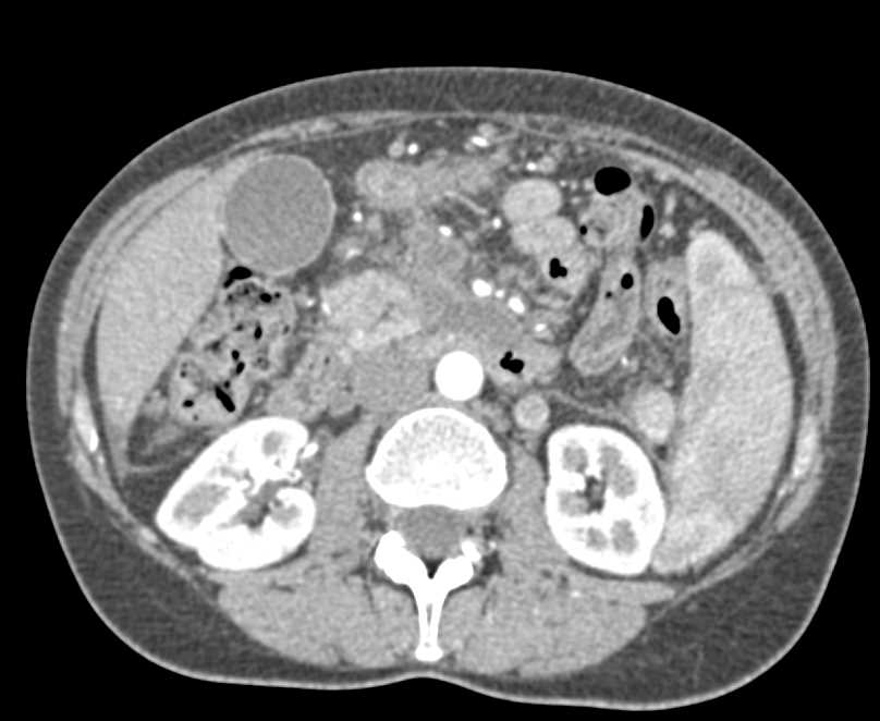 Pancreatic Adenocarcinoma with Arterial and Venous Involvement - CTisus CT Scan