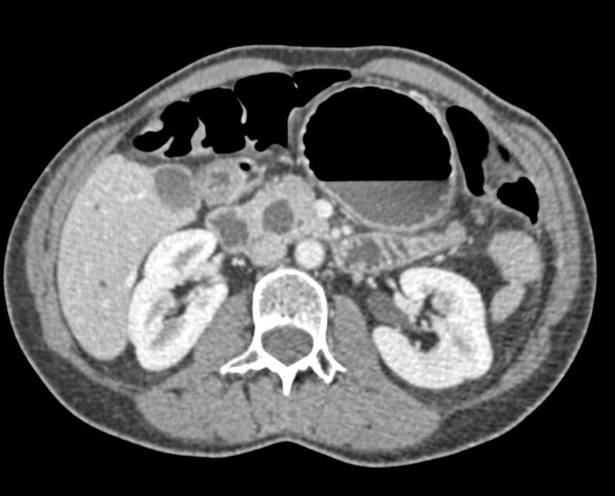 Intraductal Papillary Mucinous Neoplasm (IPMN) in Head of Pancreas - CTisus CT Scan