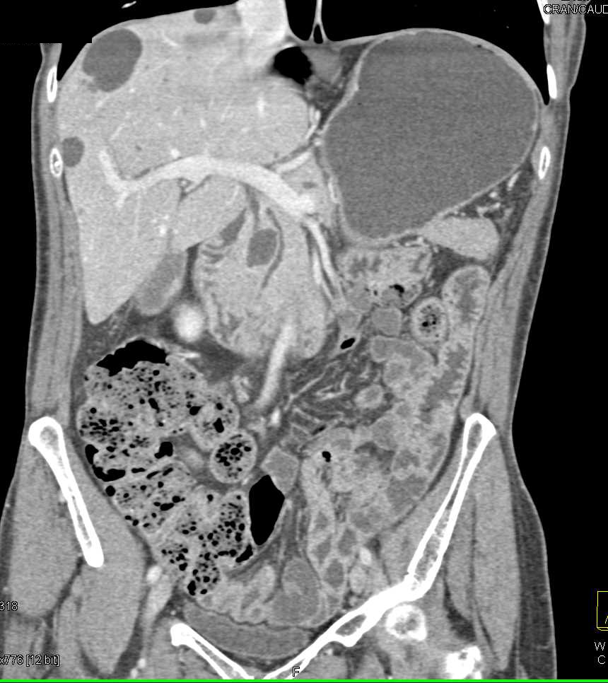 Intraductal Papillary Mucinous Neoplasm (IPMN) in Head of Pancreas - CTisus CT Scan