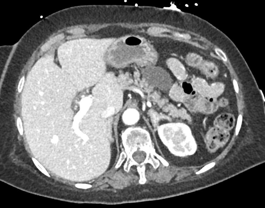 Pancreatitis and Pseudocysts - CTisus CT Scan