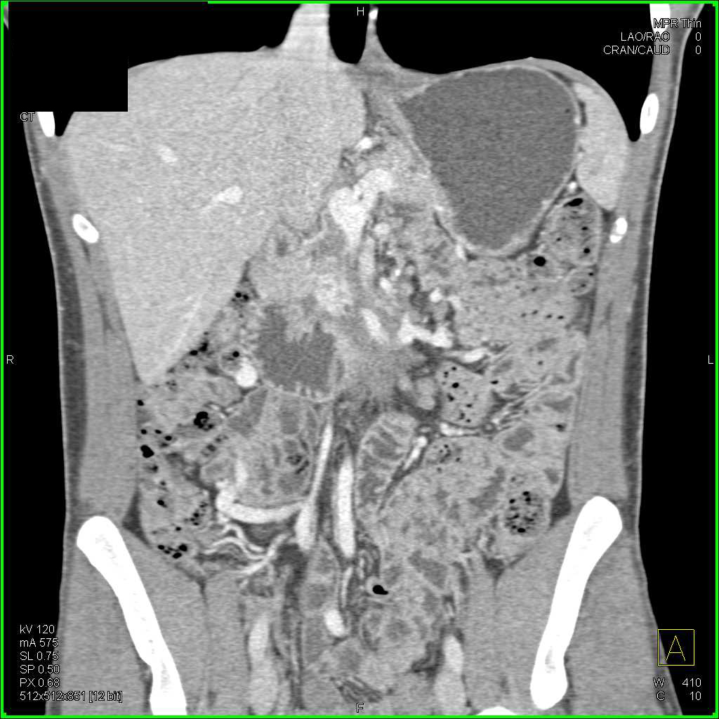 Pancreatic Cancer with Vascular Occlusion - CTisus CT Scan