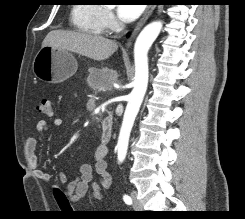 Pancreatic Adenocarcinoma with Arterial Encasement - CTisus CT Scan