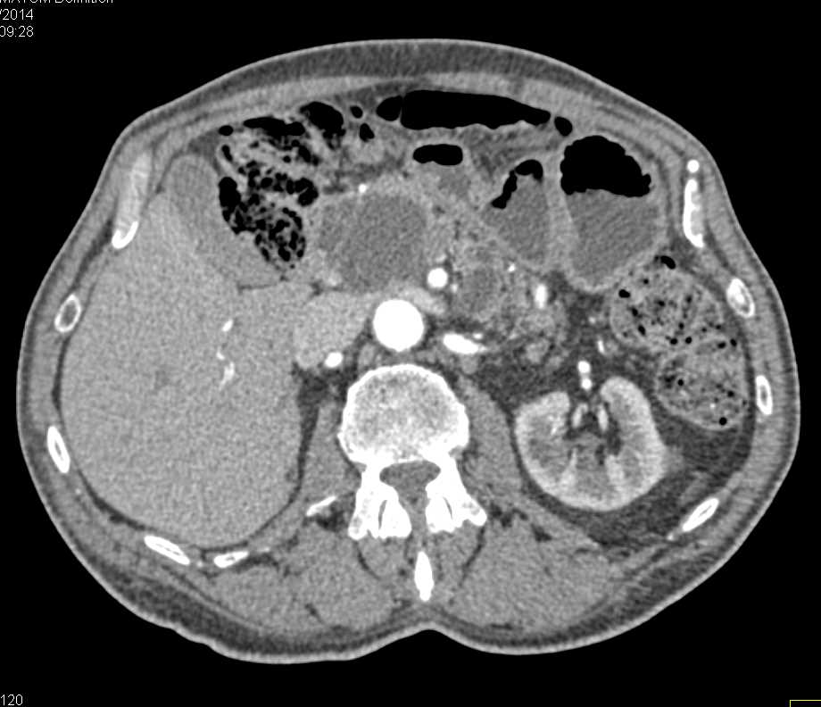 Multiple Pancreatic Pseudocysts - CTisus CT Scan