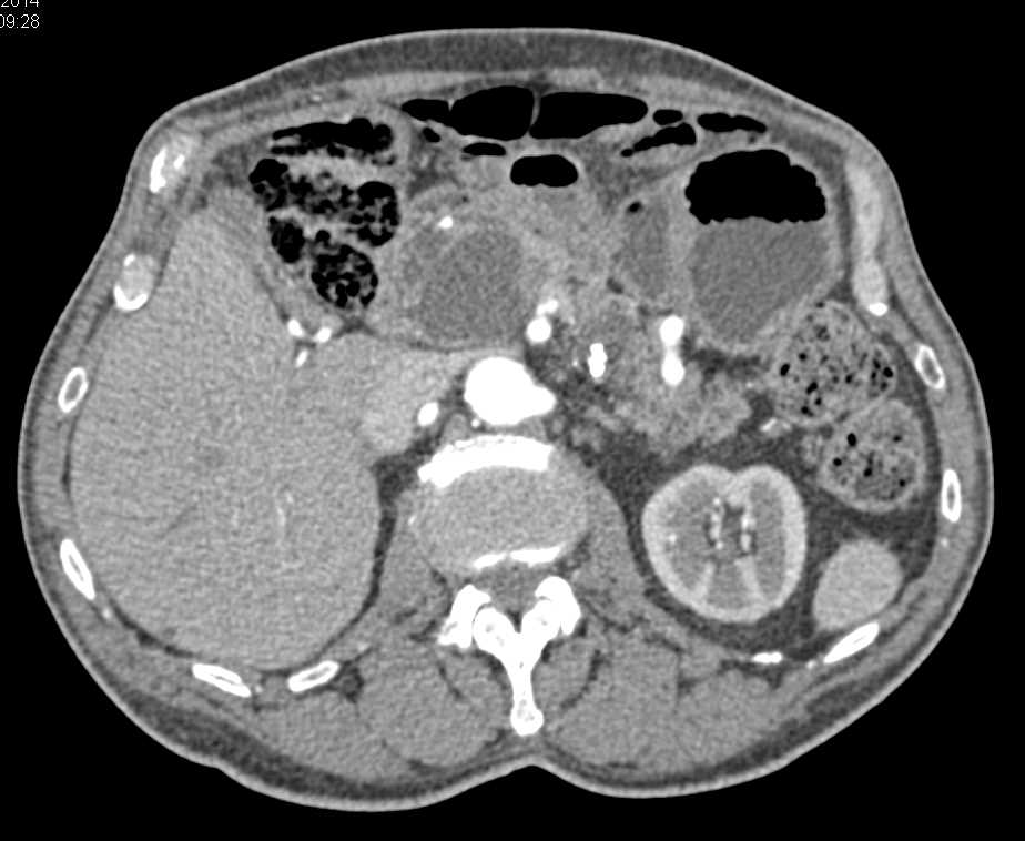 Multiple Pancreatic Pseudocysts - CTisus CT Scan