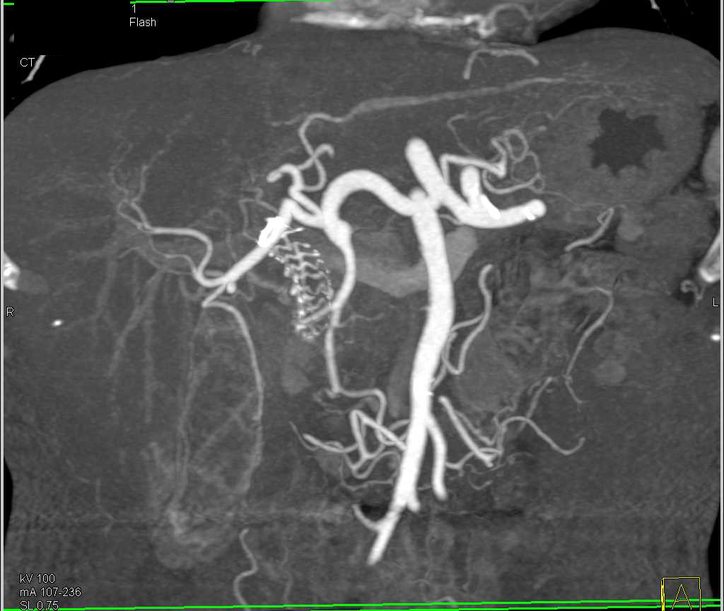 Carcinoma of the Head of the Pancreas - CTisus CT Scan