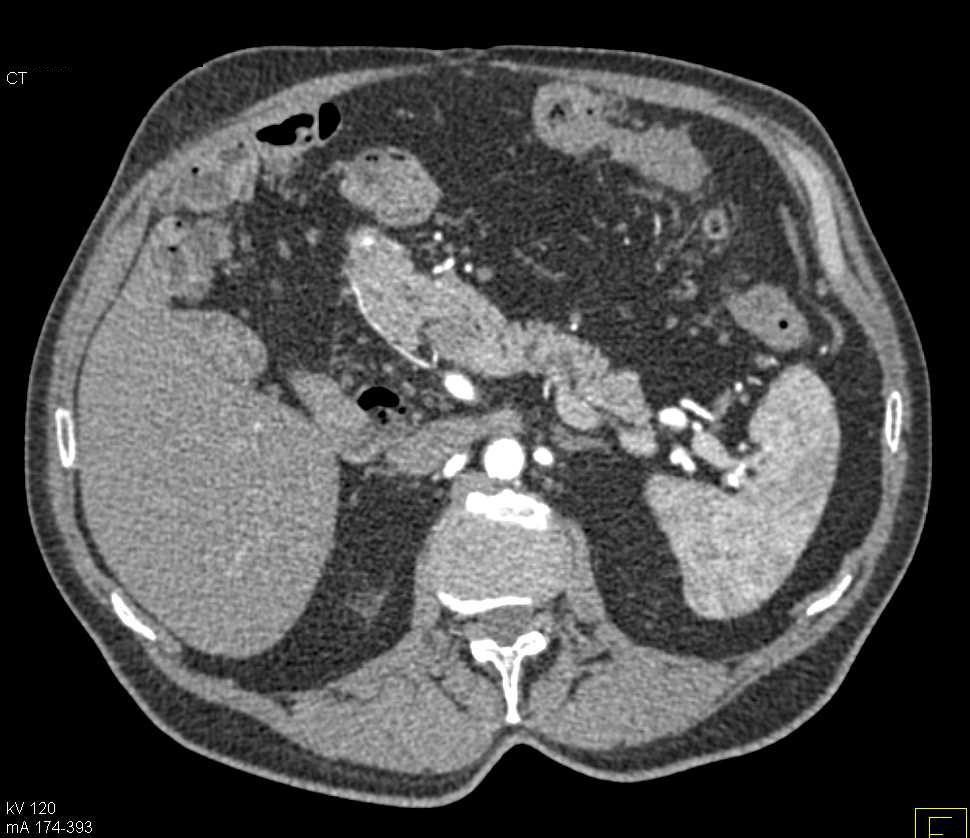 Small Pancreatic Intraductal Papillary Mucinous Neoplasm (IPMN) - CTisus CT Scan