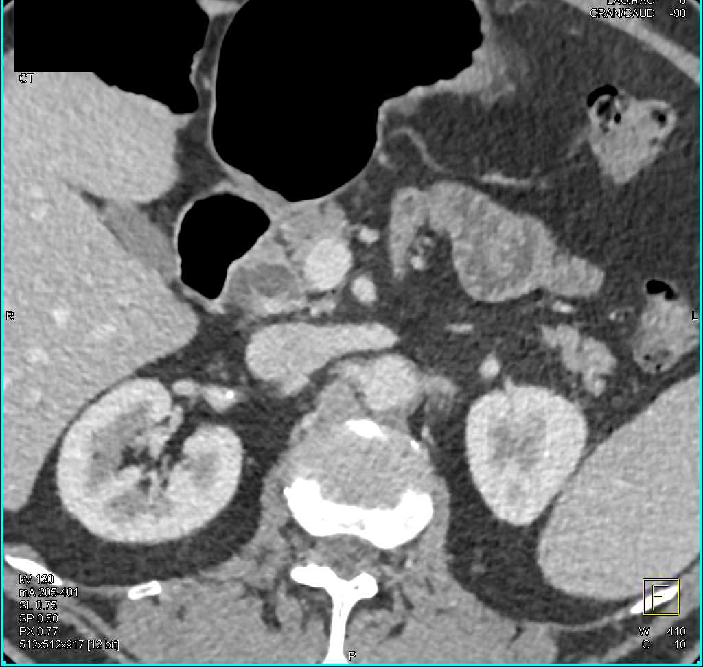 Ampullary Carcinoma - CTisus CT Scan