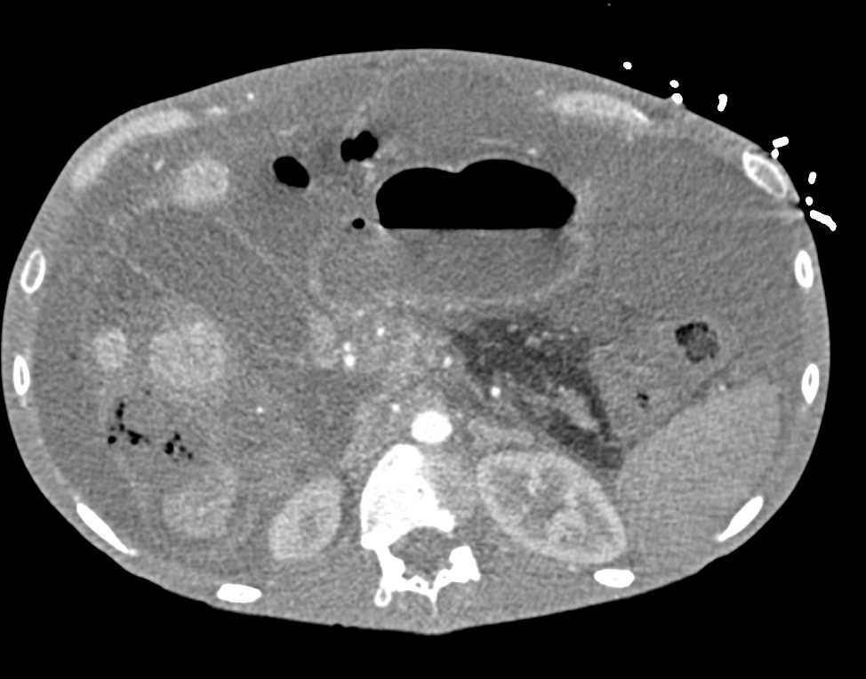 Carcinomatosis from Pancreatic Cancer - CTisus CT Scan