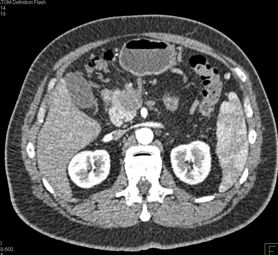 Pancreatic Cancer Encases the Celiac Artery - CTisus CT Scan