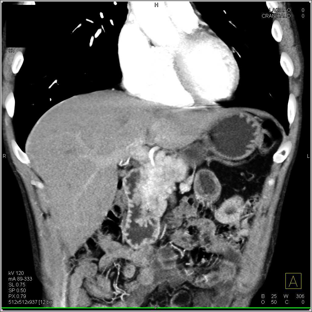 Neuroendocrine Tumor Head of Pancreas - CTisus CT Scan