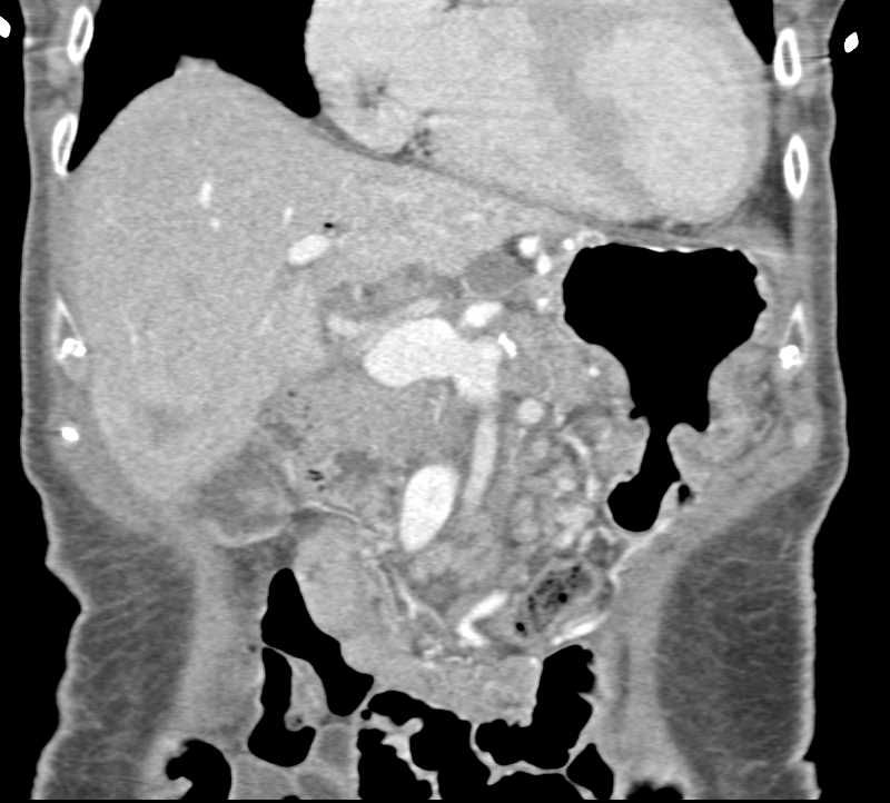 Metastatic Pancreatic Adenocarcinoma with Adenopathy and Lung and Liver Metastases - CTisus CT Scan