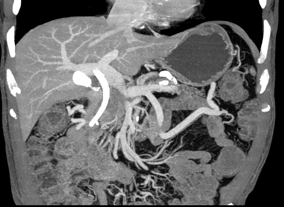 Pancreatic Cancer Encases the PV/SMV/Splenic Vein Confluence - CTisus CT Scan