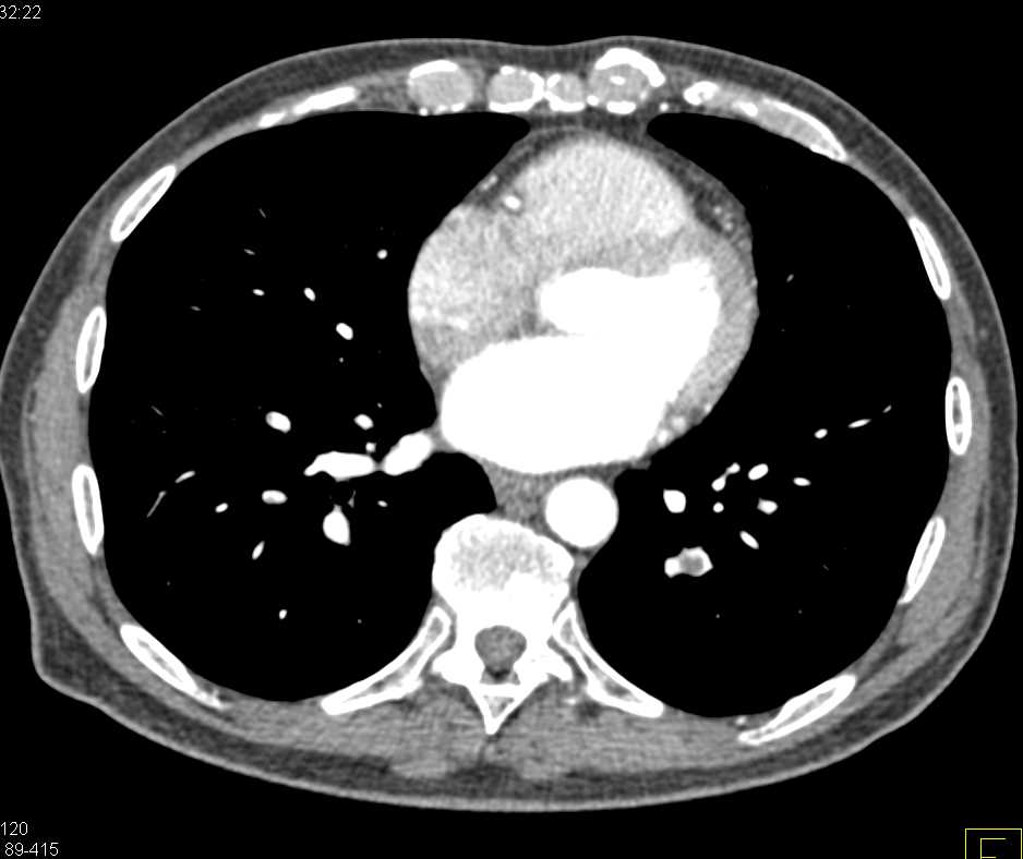 Incidental Pulmonary Embolism in a Pancreatic Cancer Patient - CTisus CT Scan