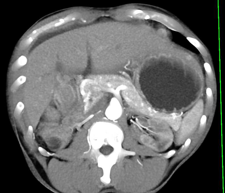 Normal Enhancement of the Pancreatic Gland - CTisus CT Scan