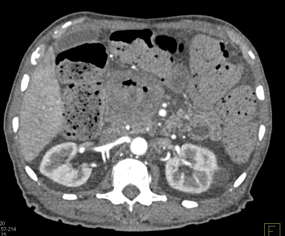 Pancreatic Cancer with Liver Metastases - CTisus CT Scan