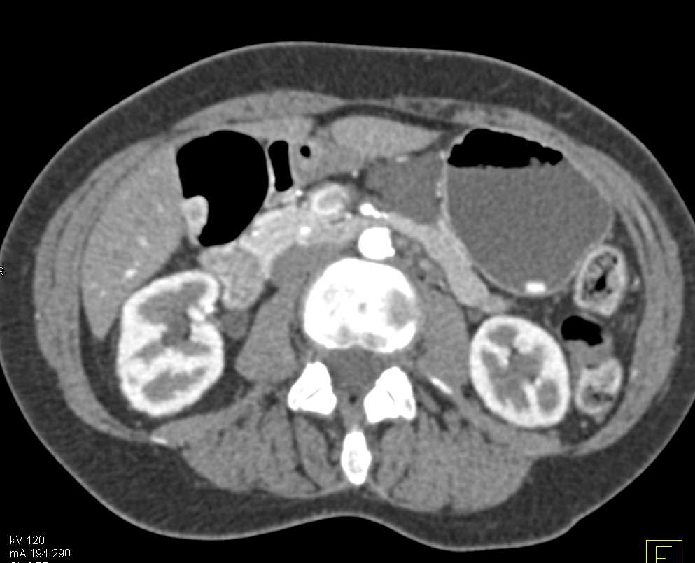 Lymphoepithelial Cyst Pancreas Simulates a Duplication Cyst Stomach - CTisus CT Scan