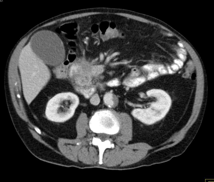 Pancreatic Cancer with Portal Vein Involvement - CTisus CT Scan