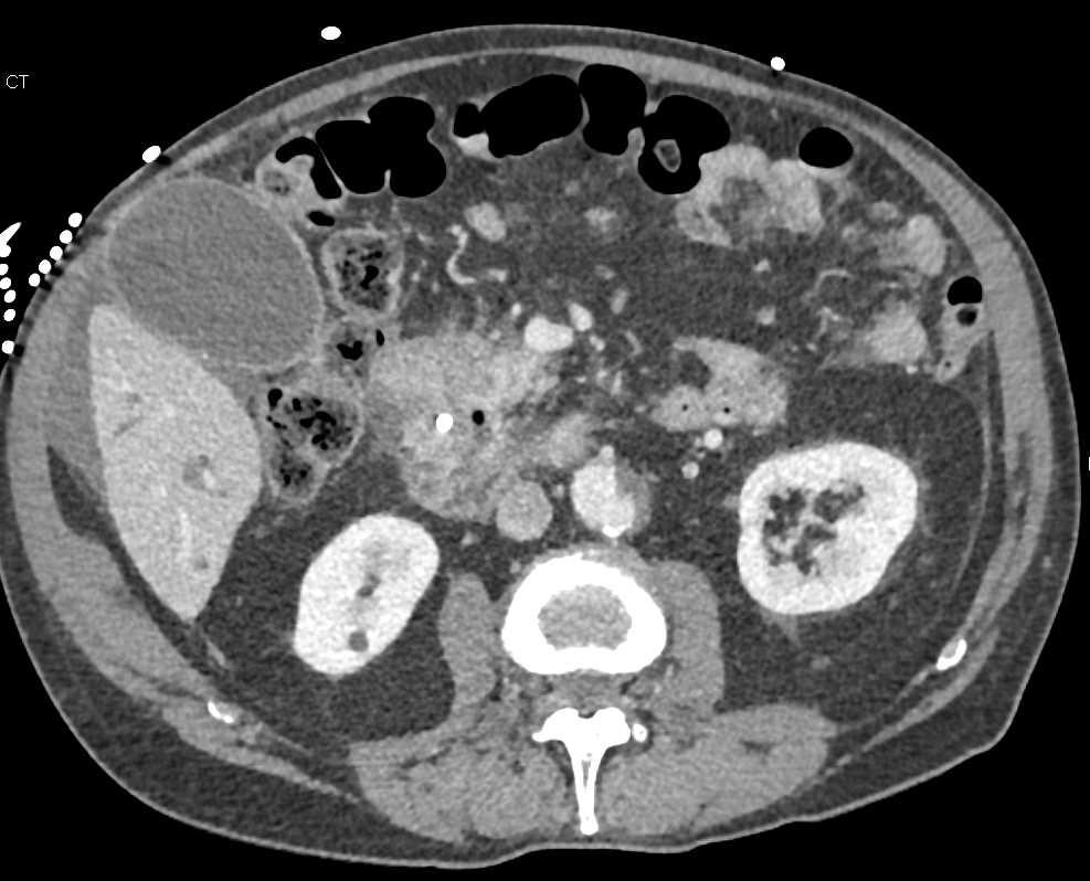 Pancreatic Cancer with Portal Vein Involvement Especially Left Portal Vein - CTisus CT Scan