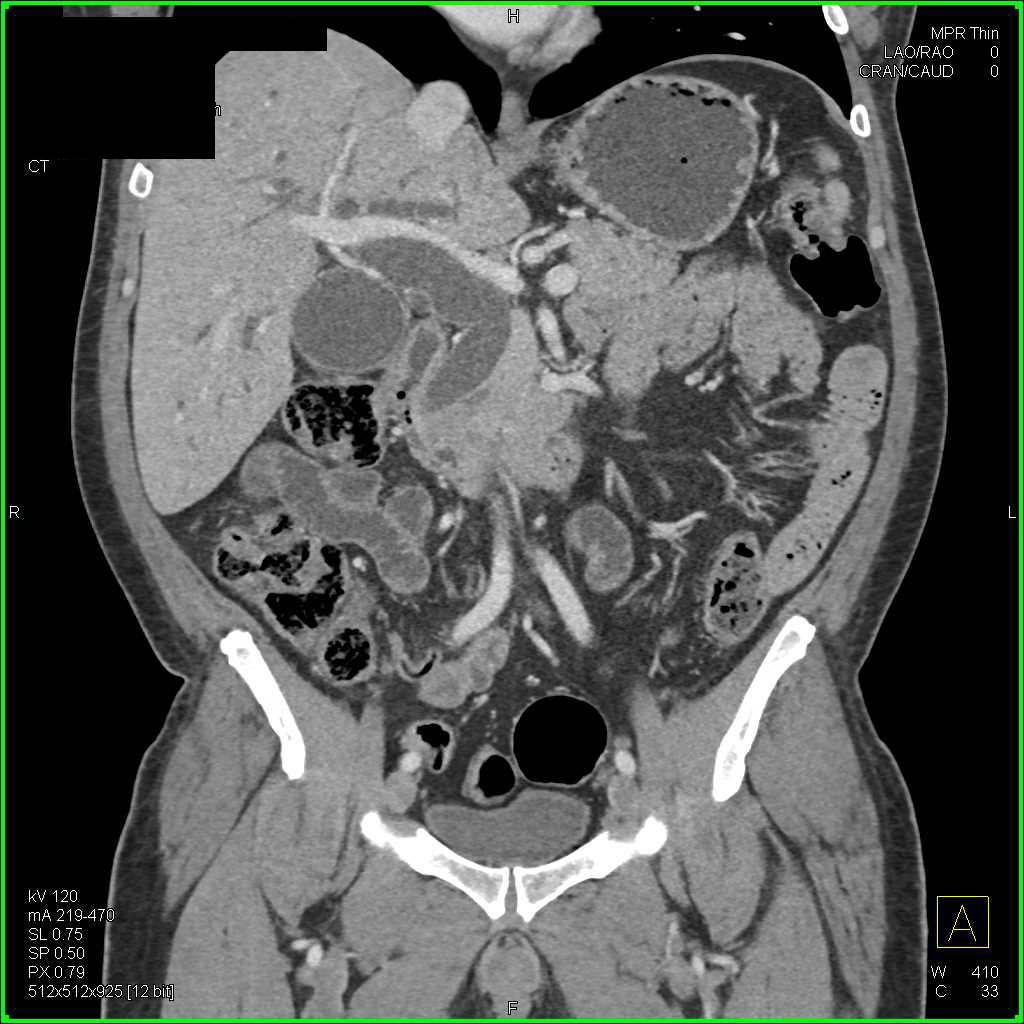 Pancreatic Cancer Obstructs the Common Bile Duct - CTisus CT Scan