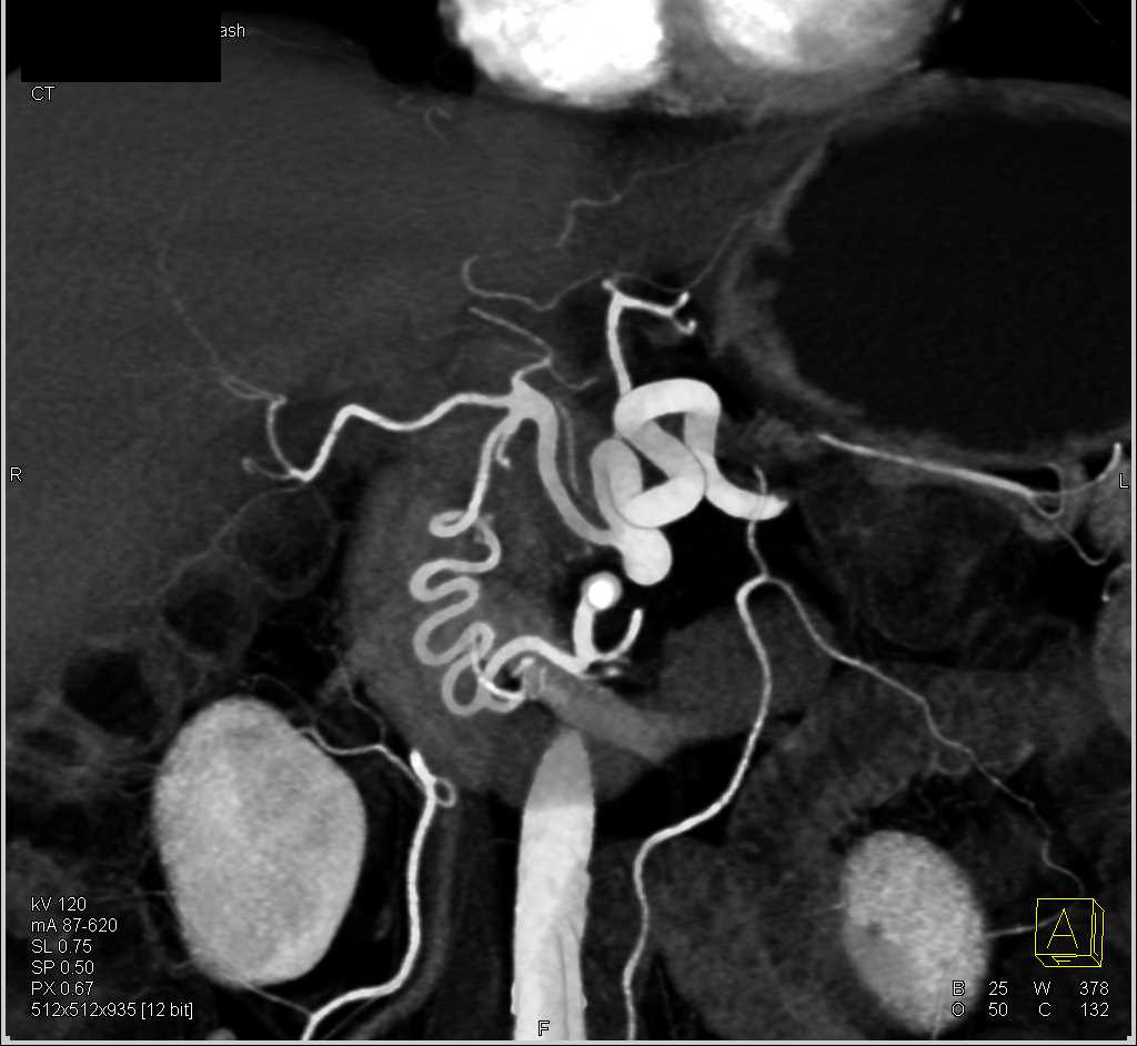 Pancreatic Cancer with Occlusion Celiac Axis with Collateral Pathways Including Prominent Gastroduodenal Artery (GDA) - CTisus CT Scan