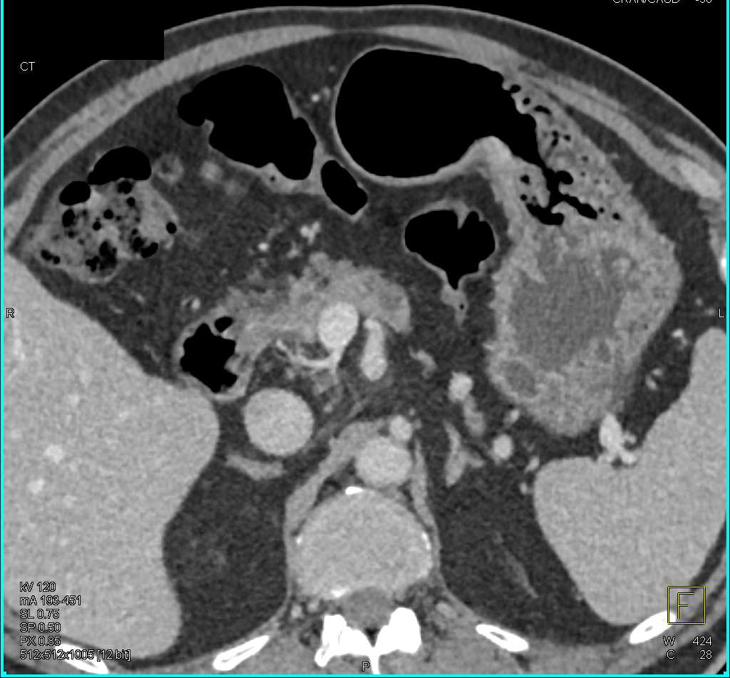 Carcinoma Arises in an Intraductal Papillary Mucinous Neoplasm (IPMN) - CTisus CT Scan