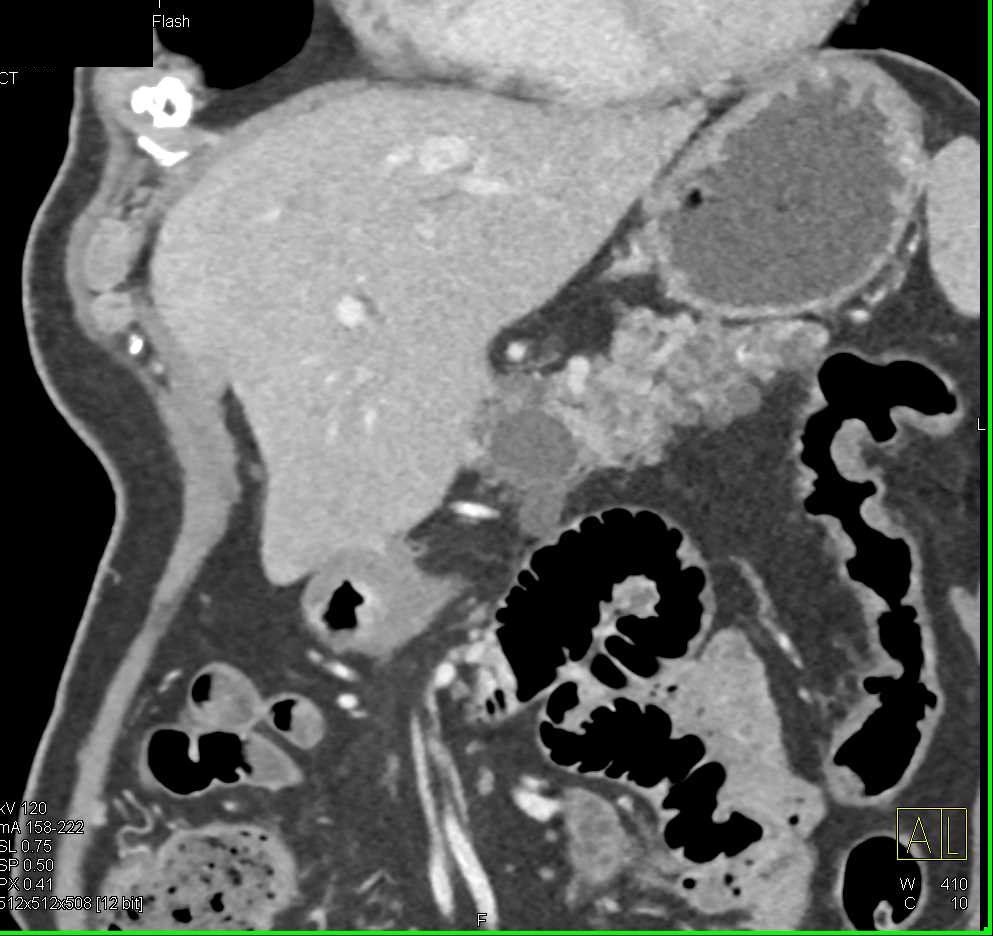 Multiple Intraductal Papillary Mucinous Neoplasms (IPMNs) in the Pancreas - CTisus CT Scan