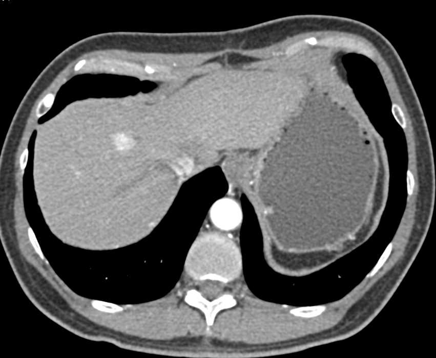 Neuroendocrine Tumor Pancreas Metastatic to the Liver - CTisus CT Scan