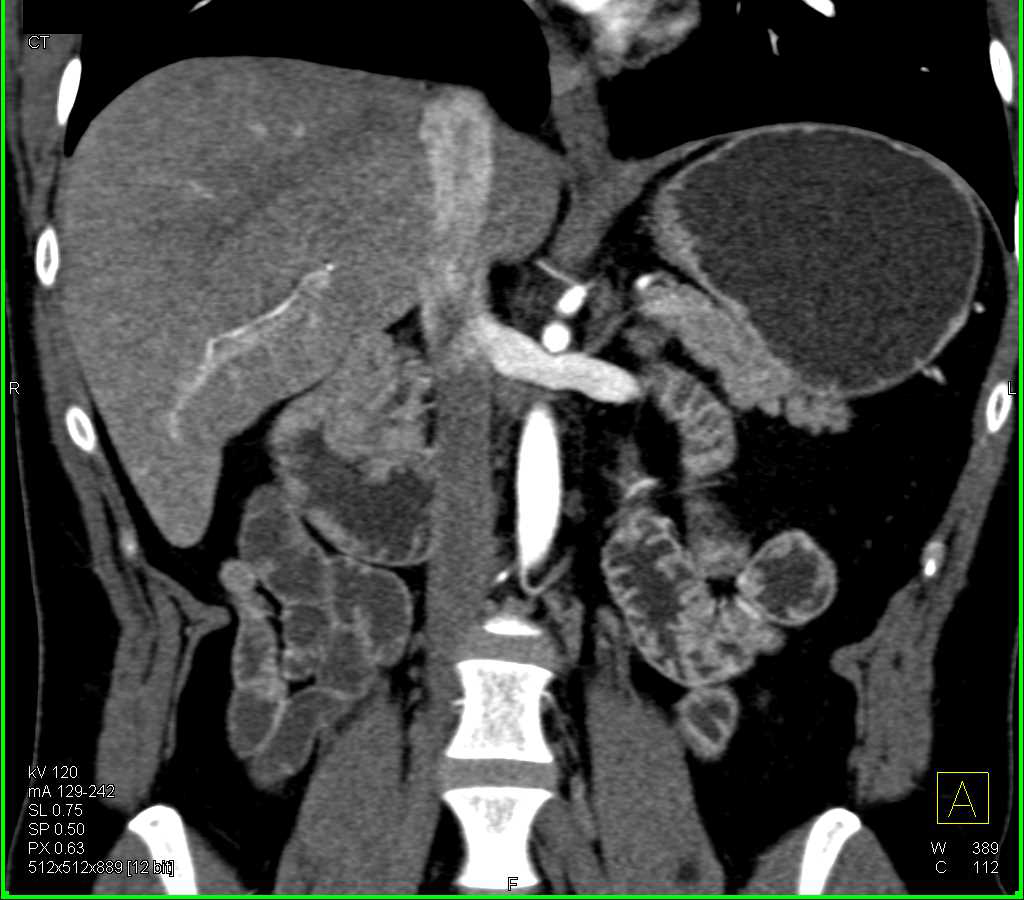 Ampullary Carcinoma - CTisus CT Scan